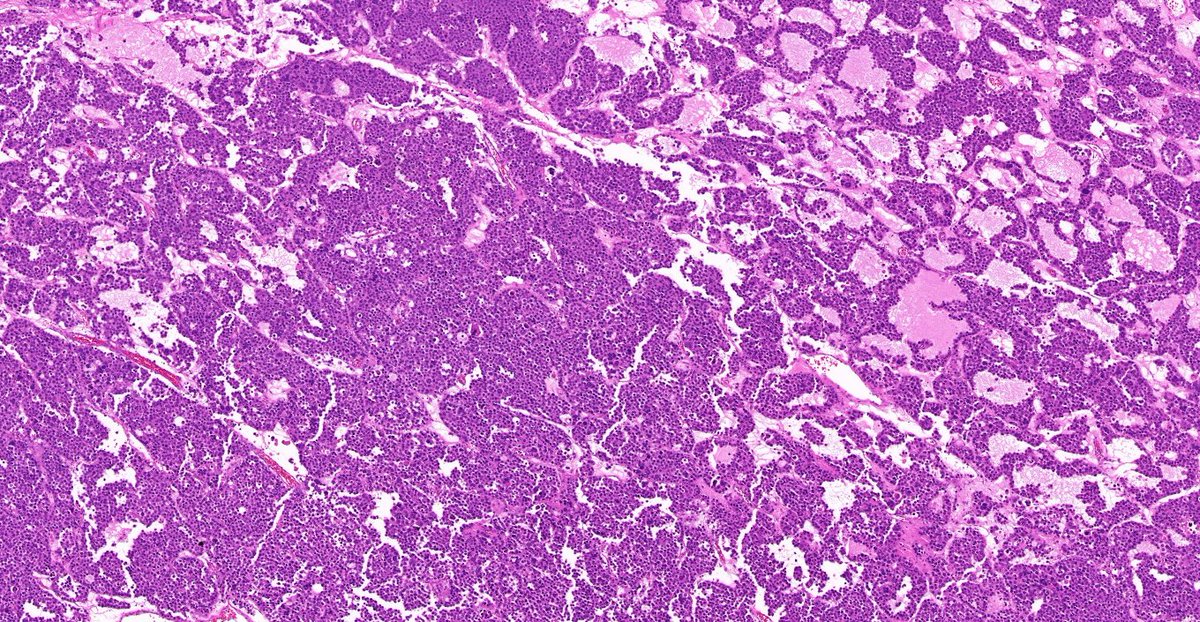 TristanRutland7's tweet photo. Testis, Adult

#GUpath #Surgpath #Pathtwitter https://t.co/hu9kF2dy3p