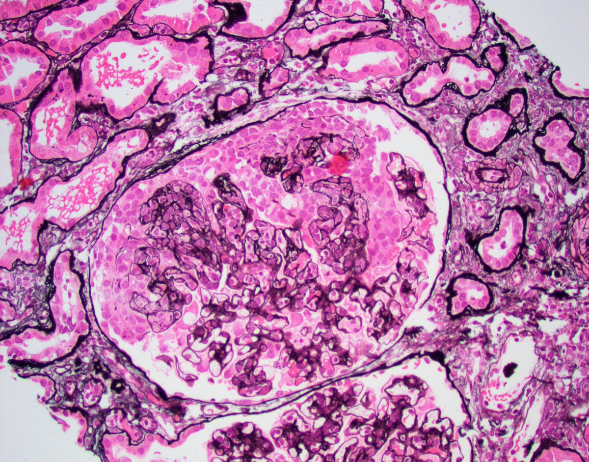 Interesting case of chronic active ABMR with superimposed collapsing glomerulopathy. Also features of chronic CNI effect. Several years post txp. #renalpath #nephropath