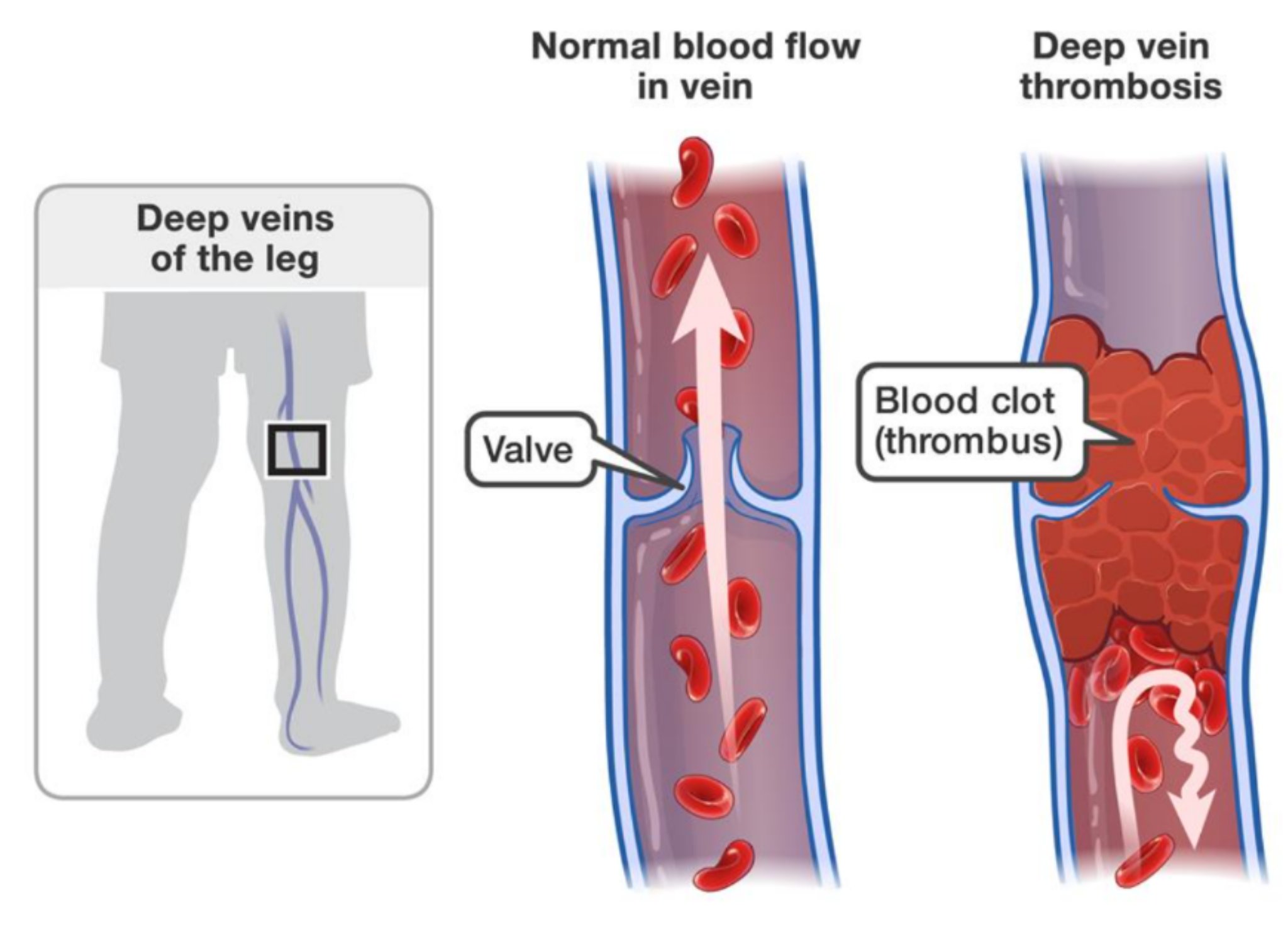 NotesFromTheER on Twitter "DVT = Deep Vein Thrombosis. More common in