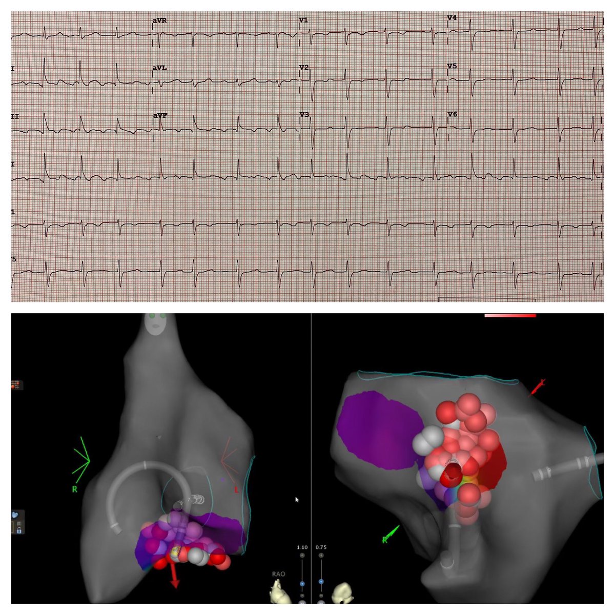 JamesKnellerMD's tweet photo. 60s male with childhood VSD, PDA repair, referred for AFIB ablation. Presenting rhythm shown, this was typical CTI-dependent flutter with termination during RF. Mapping by @arielisha @arielisha1 #nevergetsold #epeeps #biosensewebster #ep_fellow #ep_fellows https://t.co/5IzERz1hiu