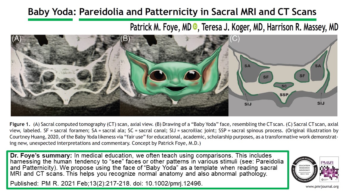 TailboneDoctor's tweet photo. #BabyYoda #Pareidolia and #Patternicity in Sacral MRI and CT Scans. Thrilled to be published in @PMRJournal. Baby #Yoda is within us all! #Mandalorian #Grogu #StarWars #MedTwitter #MedEd #Physiatry #PMandR #MedicalTwitter #MedicalEducation https://t.co/ZoTkheXBzY