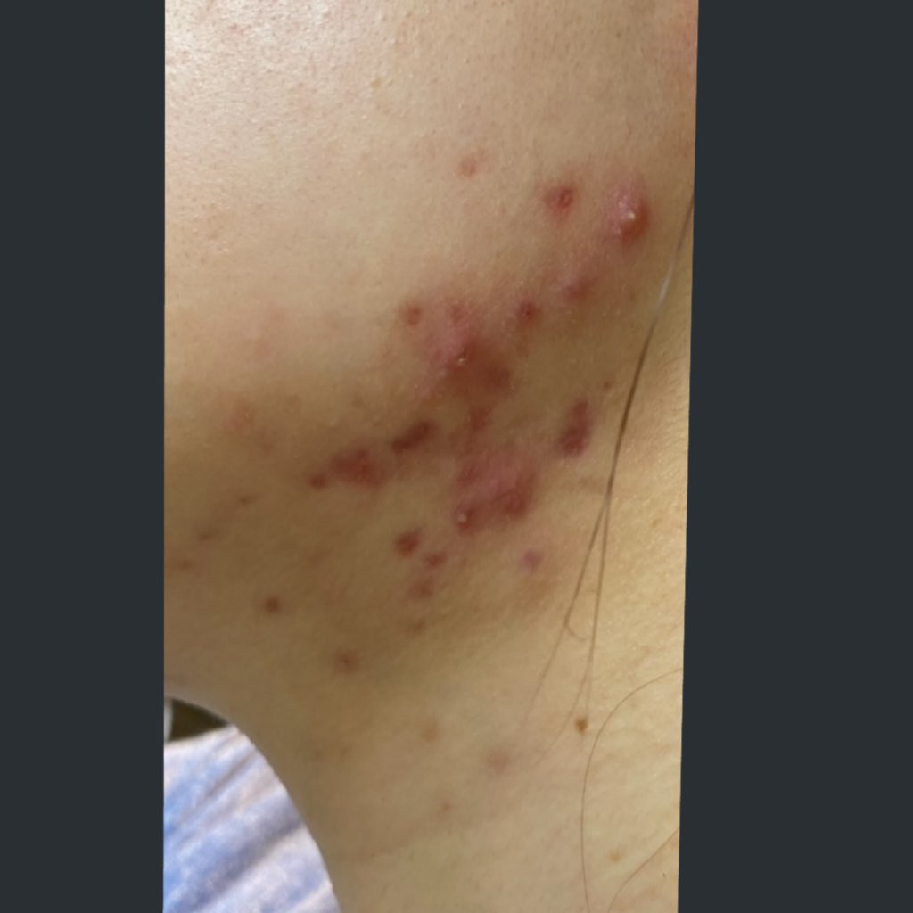 Muuko 顔はいつも通りの荒れ具合 去年の４月に普段あまり出来ないフェイスライン下が初めて大荒れした時 ディフェリンゲル処方されて頑張って塗ってたんだけど かゆみと熱がこもった感がすごくて 違う皮膚科に行ったらディフェリンゲル自体が合わなくて