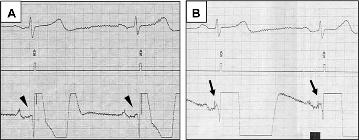ShaojieChen1's tweet photo. deeper position, less threshold, for highly selective / stable #HISPacing, technique and anatomy, from Iida et al
@HRSonline and from Cabrera et al @ACCinTouch #pacemaker #EPeeps https://t.co/nGbqixTIyE