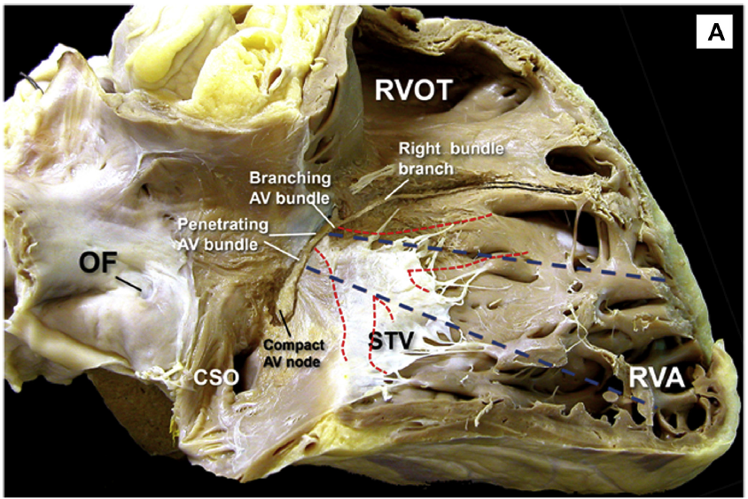 ShaojieChen1's tweet photo. deeper position, less threshold, for highly selective / stable #HISPacing, technique and anatomy, from Iida et al
@HRSonline and from Cabrera et al @ACCinTouch #pacemaker #EPeeps https://t.co/nGbqixTIyE
