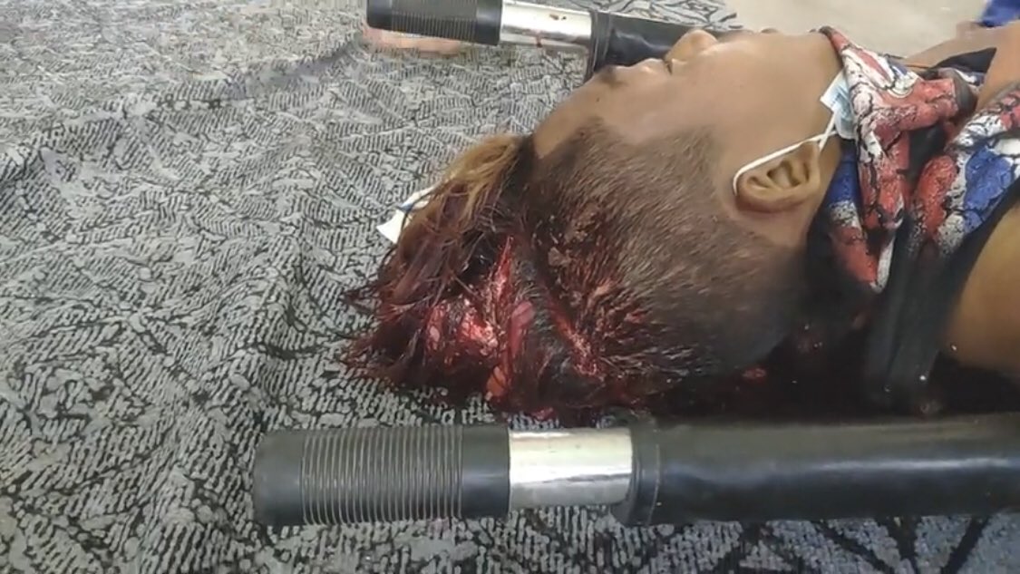 Latest updated about Mandalay, Myanmar. 
A young boy was shot with a real gun in the head and there is a confirm that “he just passed away from the gun shot.” 
#WhatsHappeninglnMyanmar 
#Feb20