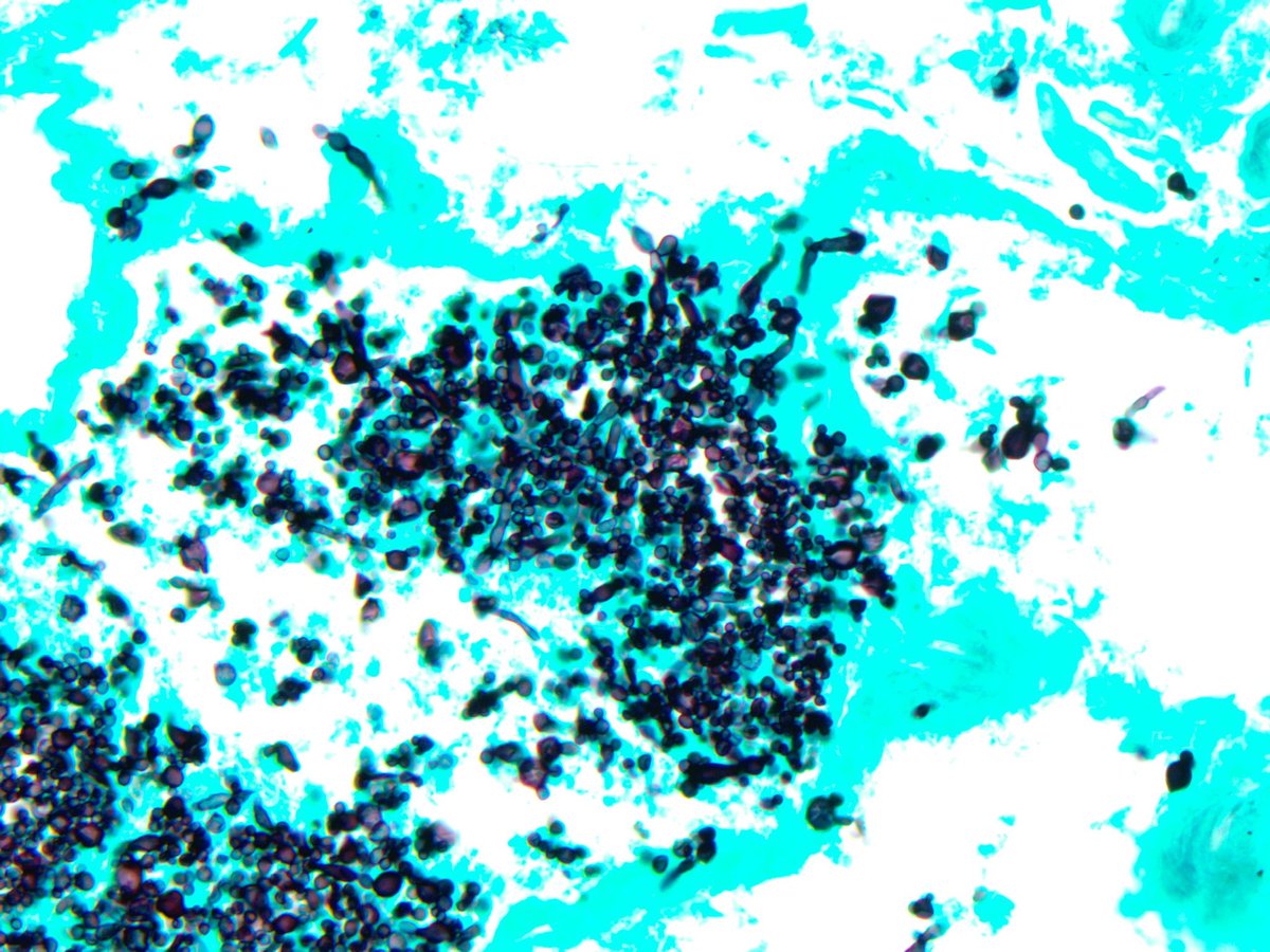 smlungpathguy's tweet image. Candida in a COVID-19 lung with DAD, thrombosis and massive unilateral infarction (GMS and Gram stains) 

Case 1 of this series 👇🏾👇🏾

pubmed.ncbi.nlm.nih.gov/33316056/

#Pathbugs #crittersontwitter #pathology #pulmpath