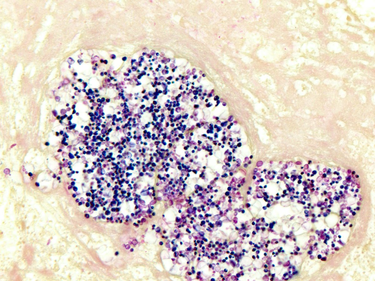 smlungpathguy's tweet image. Candida in a COVID-19 lung with DAD, thrombosis and massive unilateral infarction (GMS and Gram stains) 

Case 1 of this series 👇🏾👇🏾

pubmed.ncbi.nlm.nih.gov/33316056/

#Pathbugs #crittersontwitter #pathology #pulmpath