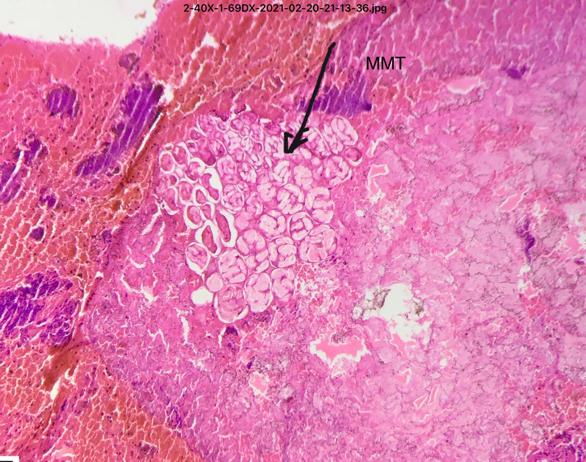 dhp_devendra's tweet image. #twitterpath 55/F, proliferative lesion in buccal mucosa. What are the structures at arrows.