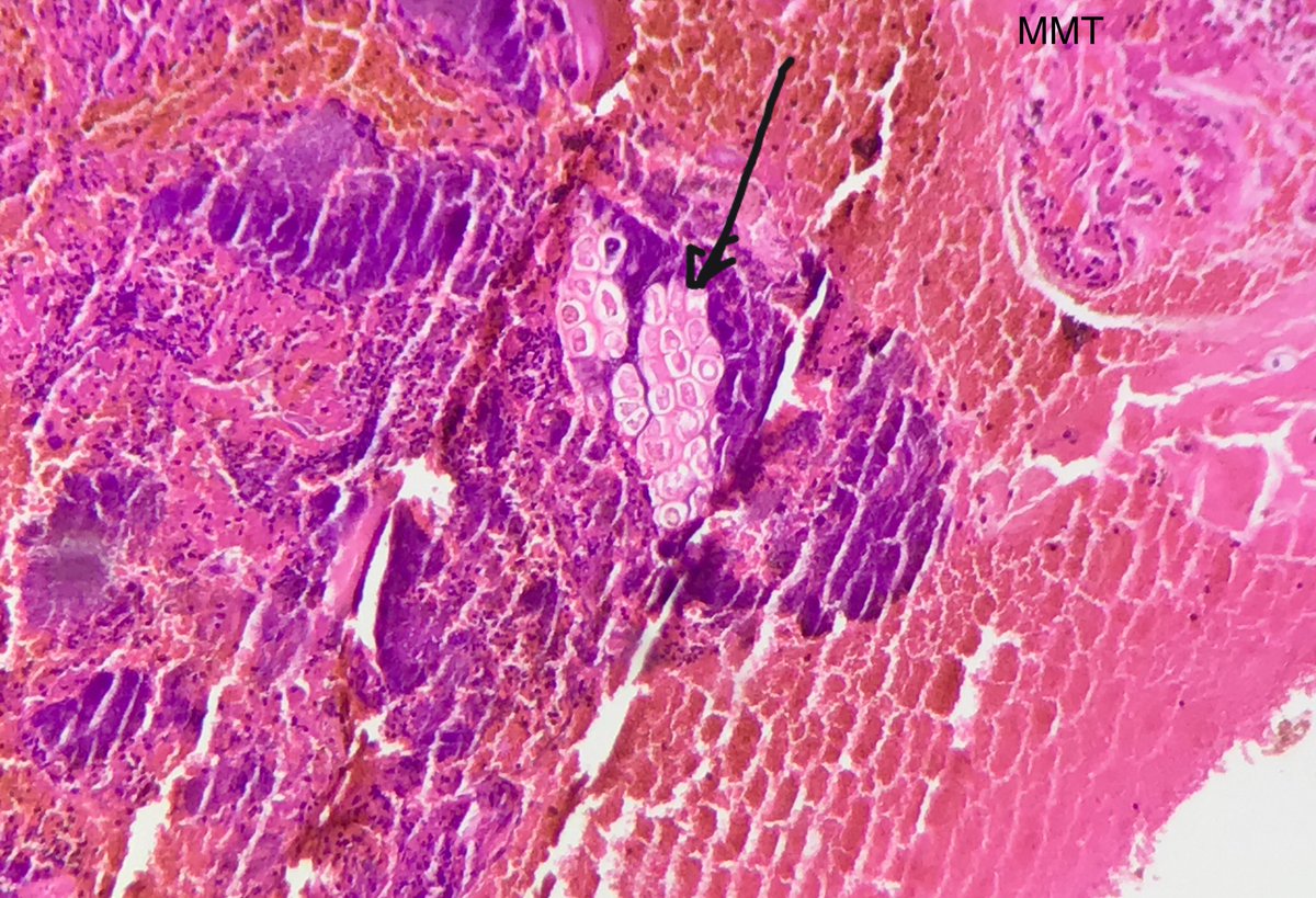 dhp_devendra's tweet image. #twitterpath 55/F, proliferative lesion in buccal mucosa. What are the structures at arrows.