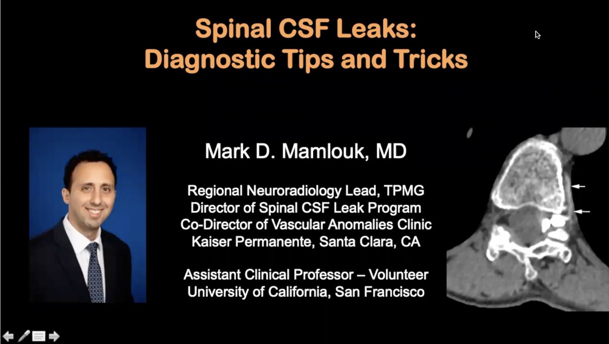 Matthew S. Parsons (@mattparsonsmd) on Twitter photo The Headache and the Spine is not finished yet. <a href="/MarkMamloukMD/">Mark Mamlouk</a> from <a href="/KPSantaClara/">Kaiser Permanente Santa Clara</a> lecturing on “Spinal CSF Leaks: Diagnostic Tips and Tricks”. <a href="/radiology_ninja/">Ichiro Ikuta, MD, MMSc</a> <a href="/PeterGKranz/">Peter Kranz</a> <a href="/The_ASSR/">American Society of Spine Radiology (ASSR)</a> The Headache and the Spine is not finished yet. <a href="/MarkMamloukMD/">Mark Mamlouk</a> from <a href="/KPSantaClara/">Kaiser Permanente Santa Clara</a> lecturing on “Spinal CSF Leaks: Diagnostic Tips and Tricks”. <a href="/radiology_ninja/">Ichiro Ikuta, MD, MMSc</a> <a href="/PeterGKranz/">Peter Kranz</a> <a href="/The_ASSR/">American Society of Spine Radiology (ASSR)</a>