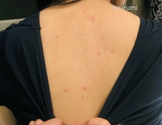 ちゅる美 元美容外科カウンセラー 背中ニキビ克服の為にヒートテックやめて無印良品の肌着 に変更 綿であったかインナー 790 綿とウール 1490 ほどよく温かくてチクチクしない タグが転写式かつ脇の縫い目無し ニキビ消失して大満足 とはいえ