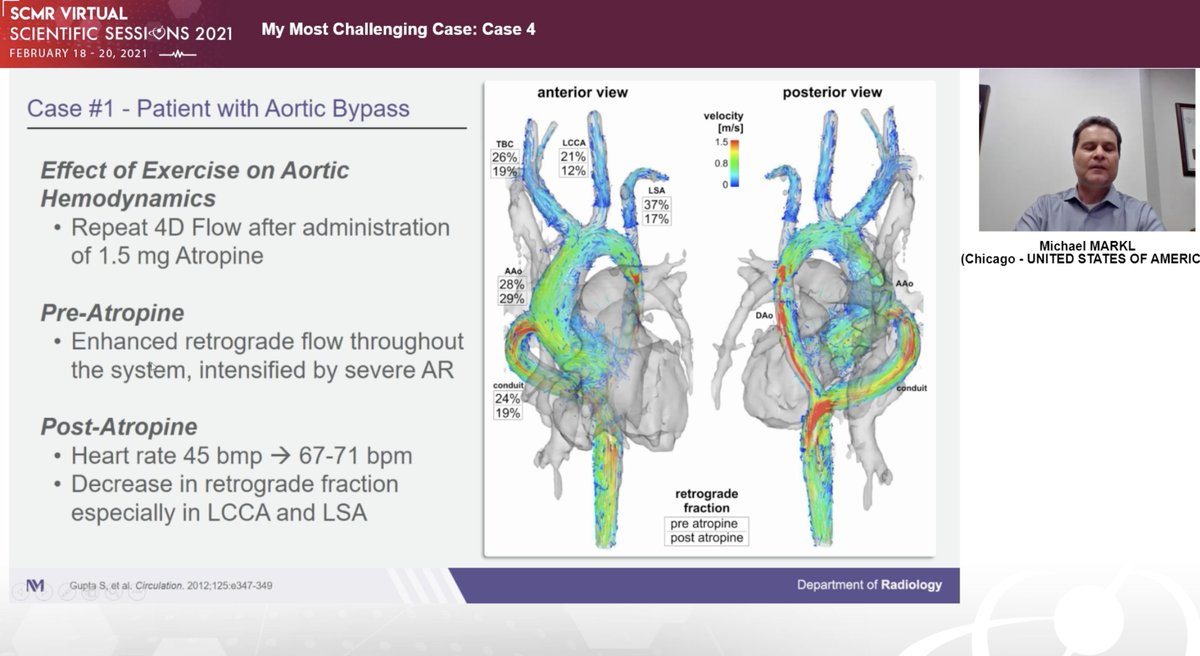 A phenomenal #WhyCMR #4Dflow physio. case by Dr. Markl in our session! 

39 ♂️🤾‍♂️ repaired Ao coarct/hypoplasia w AscAo-DescAo bypass w/ aortic regurgitation &amp; BAV

Neuro sx at rest 🧐, resolved w/ exercise

*4D flow* 👉 🔼 retrograde arch flow
🔽 arch flow w/ atropine (🤾‍♂️mimicer)