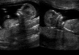 AbbyJohnson's tweet photo. Which baby was conceived in rape? If you can’t tell me, then you can’t tell me that abortion is acceptable in cases of rape. #noexceptions https://t.co/wpSNAqhnQz