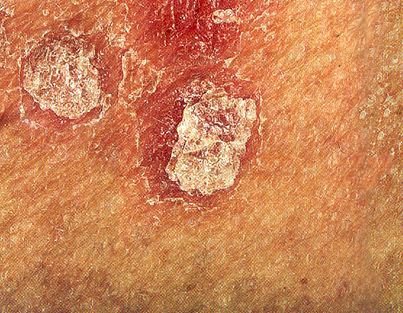 drmacrofagos's tweet photo. Signo de Auspitz

Al rascar una escama, se observa en primer lugar una segunda escama plateada que al rascarla nuevamente, prácticamente al segundo de haber sido eliminada esta última, aparecen unas gotitas de sangre.

Este signo es patognomónico de la psoriasis. https://t.co/OWABVEuLk0