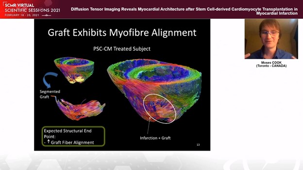 SCMR3Dplus (@scmr3d) on Twitter photo Imaging on 7T using DTI for transplanted stem cells <a href="/SCMRorg/">Society for Cardiovascular Magnetic Resonance</a> #SCMR2021. Glimpse of the future at early career scientific sessions #whyCMR Imaging on 7T using DTI for transplanted stem cells <a href="/SCMRorg/">Society for Cardiovascular Magnetic Resonance</a> #SCMR2021. Glimpse of the future at early career scientific sessions #whyCMR