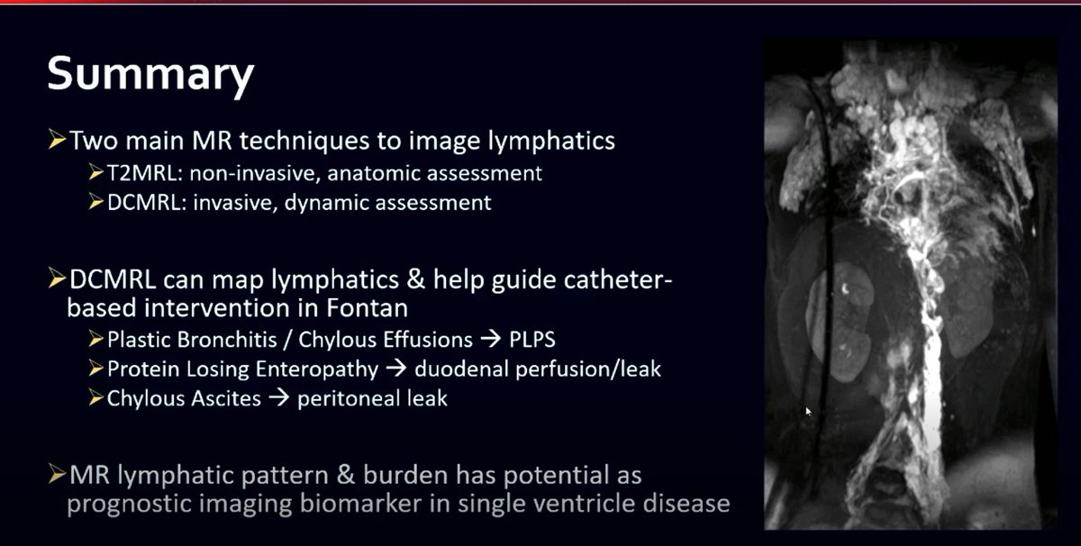 Nita Ray Chaudhuri, MD, FACC (@rayrcnita) on Twitter photo Great talk by C. Lam from Sick Kids on lymphatic assessment in Fontan❤️Classification & prognostic significance of abnormal lymphatics
❤️Lymphatic burden may help predict Fontan outcomes
❤️MR lymphatic imaging techniques
#SCMR2021 #SCMRChd <a href="/SCMRorg/">Society for Cardiovascular Magnetic Resonance</a> Great talk by C. Lam from Sick Kids on lymphatic assessment in Fontan❤️Classification & prognostic significance of abnormal lymphatics
❤️Lymphatic burden may help predict Fontan outcomes
❤️MR lymphatic imaging techniques
#SCMR2021 #SCMRChd <a href="/SCMRorg/">Society for Cardiovascular Magnetic Resonance</a>