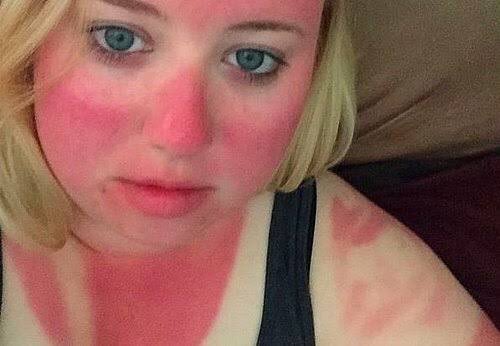 egombilir's tweet image. + tenin bembeyaz çok şanslısın 
güneşe çıktıktan 10 dakika sonra ben: