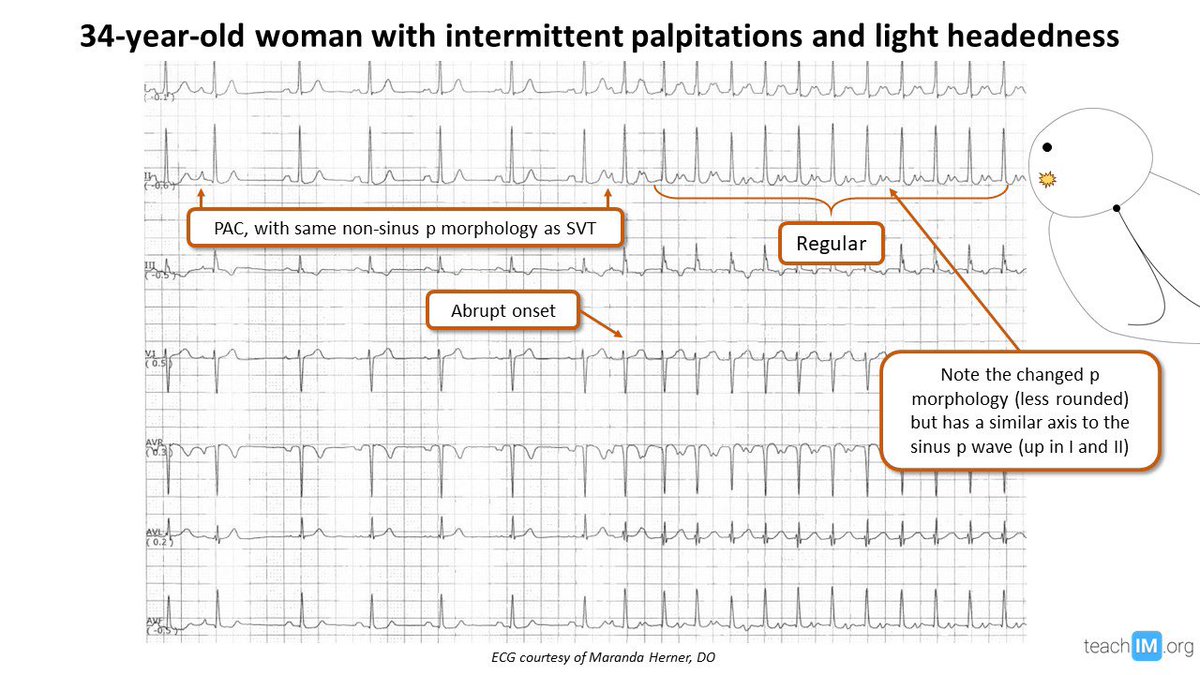 I wanted to make a joke about arrhythmias, but thought it would be tachy--use this interactive platform to help teach atrial tachycardia by 
<a href="/CUInternalMed/">CU Anschutz Internal Medicine</a>'s own Maranda Herner! #letsgettachy #teachim

Best heart puns in the comments 💕💖

View more @ teachim.org/atach
