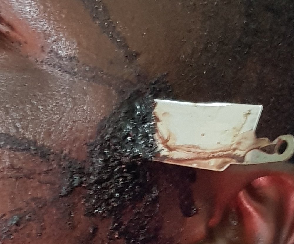 lordbuddy's tweet photo. If you got any victim with impalement injury... DO NOT PULL OUT THE OBJECT.

Seek a surgeon 1st hand.

#surgicalfirstaid

Sho! Cares... https://t.co/CHzDbLEOii