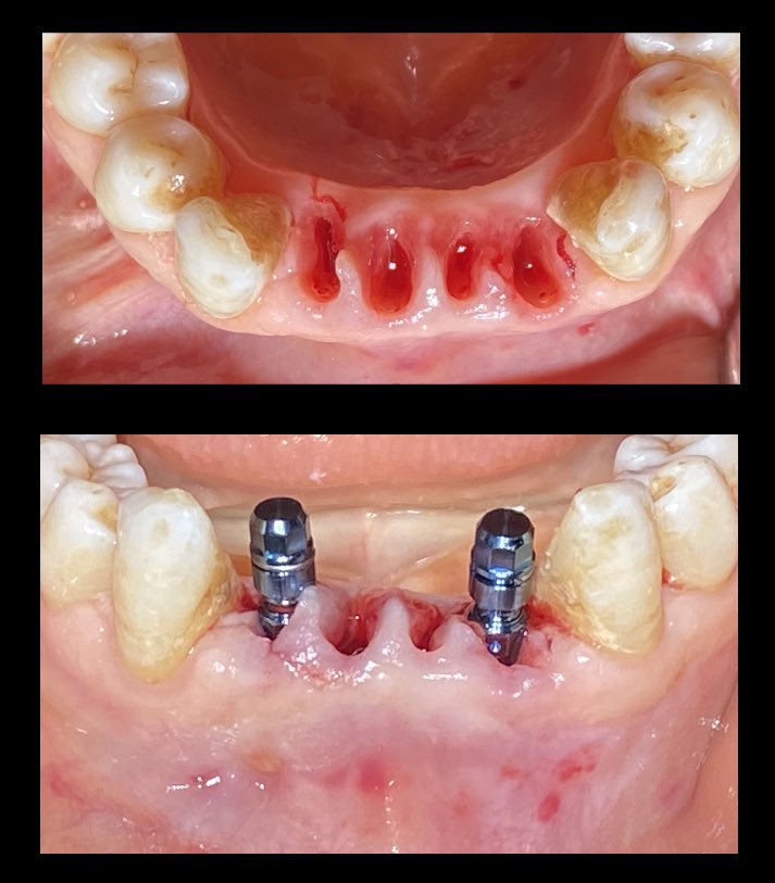 أفضل دول لزراعة الأسنان 