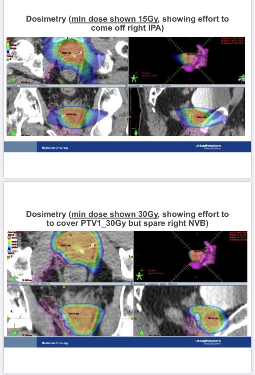 <a href="/Issarami/">Rami Issa</a> <a href="/RTendulkarMD/">Rahul Tendulkar, MD</a> Example images of case to illustrate —strong team enrolling over 50% complete despite covid <a href="/DrSpratticus/">Daniel E Spratt</a> <a href="/RTendulkarMD/">Rahul Tendulkar, MD</a> <a href="/MdStephans/">Kevin Stephans MD</a> and John Christodouleas UPenn and Tyler Robbins U Colorado