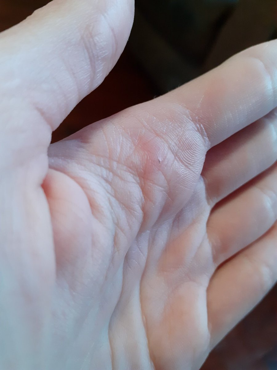 samanthap78's tweet image. *se entierra una astilla*
Automáticamente yo: TENGO MICETOMA
#IDproblems #infectoalfin