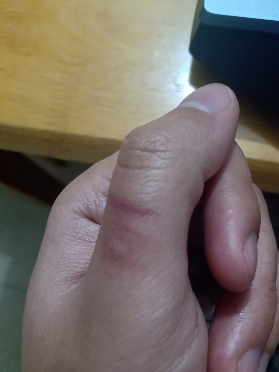 UnknownUserSD's tweet image. Banda, me quedó cicatriz.
Bale berga la bida