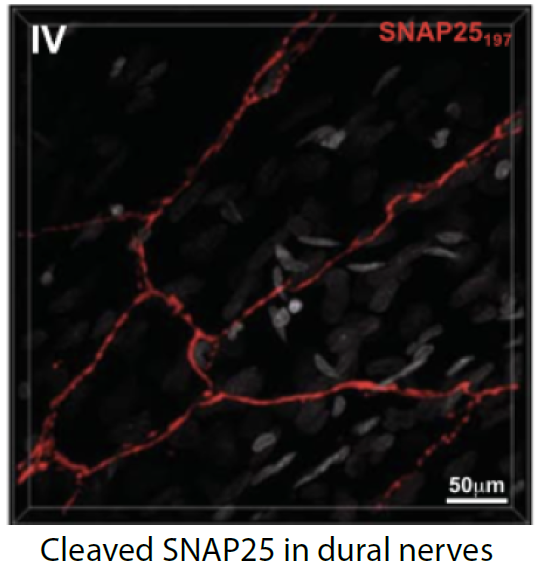Seven days after injecting #onabotulinumtoxinA to the scalp, we found cleaved #SNAP25 in intracranial meningeal nerve fibers. We suspect that the cleaved SNAP25 reached the #dura through suture branches of dural nerves. <a href="/PAINthejournal/">PAIN Journal</a> #migraine #headache👉bit.ly/37xotWT