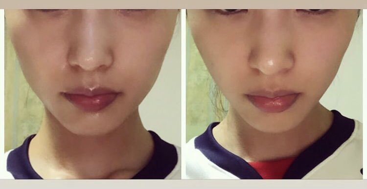 Kaede ガルバでこんなに小顔になっちゃった ガルバはやめられない 小顔 ガルバ ホリスティック 美容 エステ ニキビ 毛穴 スキンケア