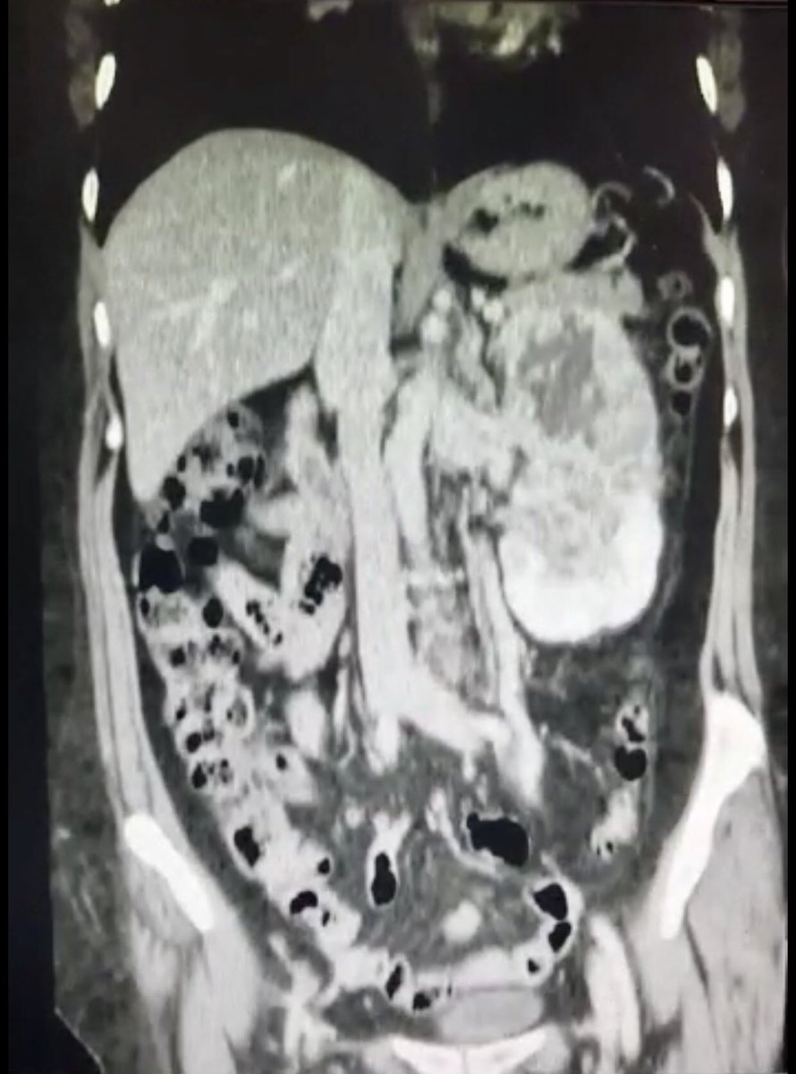 urovictore's tweet photo. Tumor Renal Izquierdo T3a N1 M0
Nefrectomía Radical Transperitoneal.

#UroSoMe #kidneycancer https://t.co/HkI0niNuyV