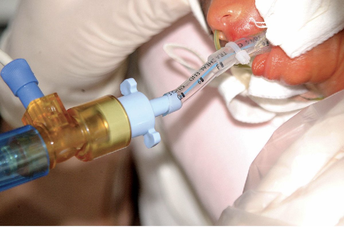 There is something incredible about the first time a parent hears their #preemies voice after being intubated at birth. 

It may be a weak cry but it’s there. 

B4 you extubate have parents get ready to capture it on their 📲.  

U get one shot. Don’t miss it!
#neotwitter #Meded
