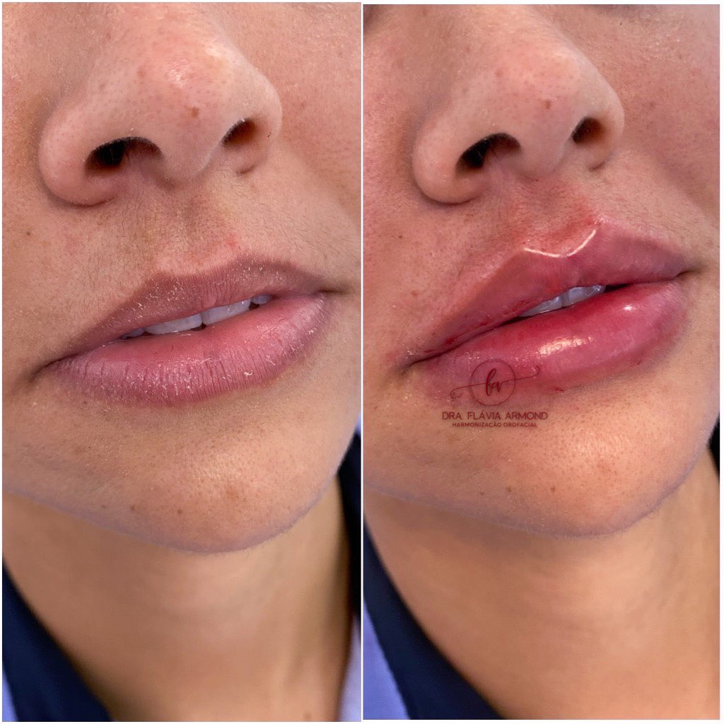 flavinhaarmond's tweet image. Preencher um lábio não é só injetar ácido hialurônico. A técnica correta permite equilibrar proporções e uma maior definição do lábio,lembrando que o resultado é indivíduos varia de acordo com o formato de cada lábio 💋❤️ #preenchimentolabial