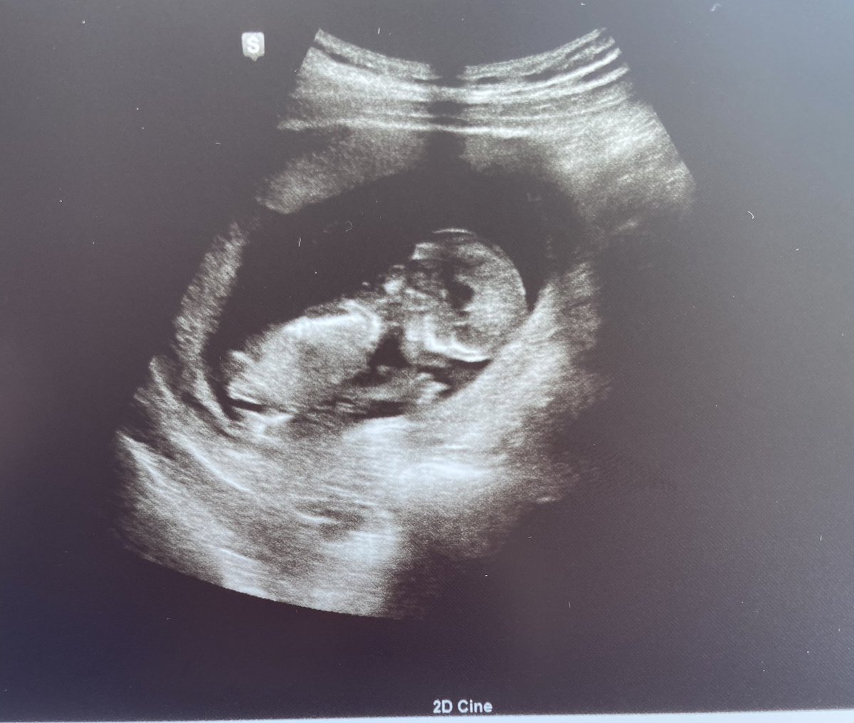 Life update 👶🏽😅🙏🏼❤️❤️❤️

We’re having a SON!!!! 

The thought of being a dad gets me so excited I don’t have the words!!! This is going to be the best job I’ll ever have. 

My boy is already so loved and taken care of. 4L🤞🏼