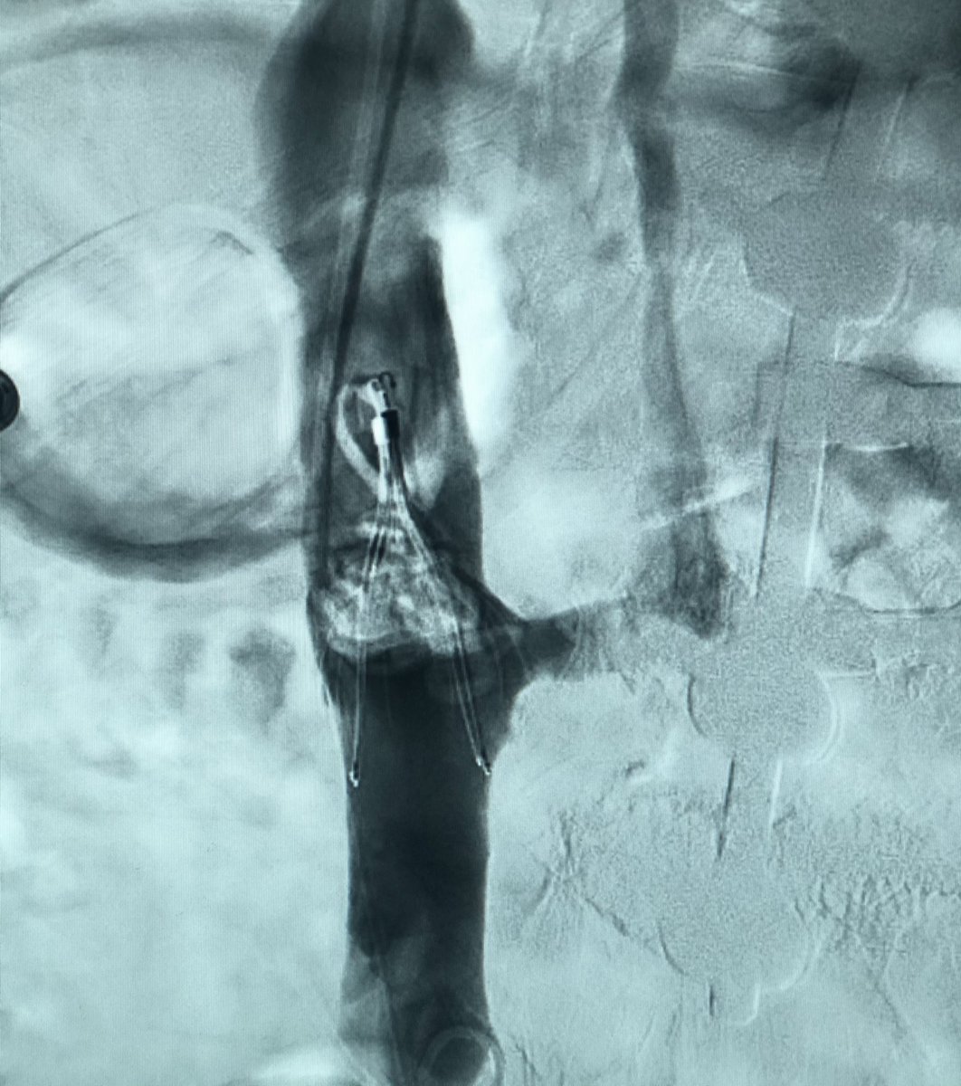 85 yo M Celect filter <a href="/cookvascular/">Cook Vascular</a> 6 mo ago for DVT/PE + contraindication to anticoagulation, here for retrieval. Unknown to us, spine surgery (outside hospital) did cement vertebroplasty of fused lumbars. Good thing that filter was there! Note ⬆️ flow azygous vein #iRad #FOAMed