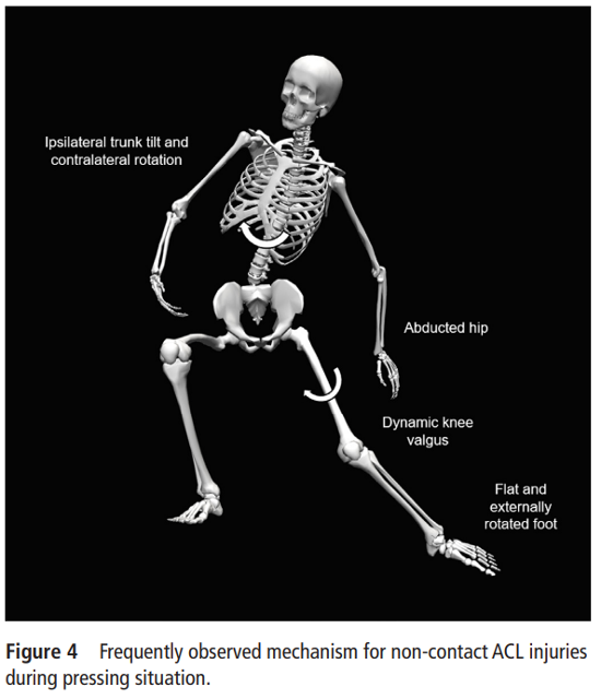 BJSM_BMJ's tweet photo. Football ACL injuries : how, where, and when do they happen? A #KnowledgeTranslation blog by @FDellaVilla ⚽🏃‍♂️

https://t.co/nyp9parQZ9 https://t.co/NoWmxpdAcj