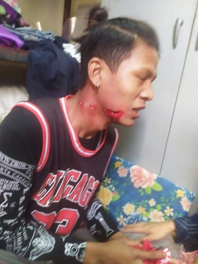 tw//Blood , gun shot
Today Myanmar : Bagan
A young protester in #Bagan was shot with rubber bullet by Junta's terrorists.
R2P FOR MYANMAR

#WhatsHappeningInMyanmar
#Mar7Coup