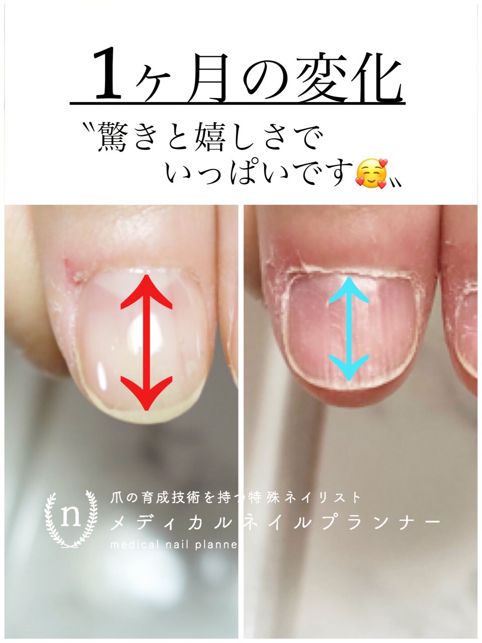 新潟爪育成ネイルサロン Venus お久しぶりの投稿 今日は自爪育成のお客様 なんと 4週間でこの変化です 爪のコンプレックス変えられます 新潟 新潟市 新潟カフェ 新潟ネイル 新潟爪育成 新潟市東区 新潟市北区 新潟市中央区 新潟市西区 新潟爪育成ネイルサロン Venus お久しぶりの投稿 今日は自爪育成のお客様 なんと 4週間でこの変化です 爪のコンプレックス変えられます 新潟 新潟市 新潟カフェ 新潟ネイル 新潟爪育成 新潟市東区 新潟市北区 新潟市中央区 新潟市西区