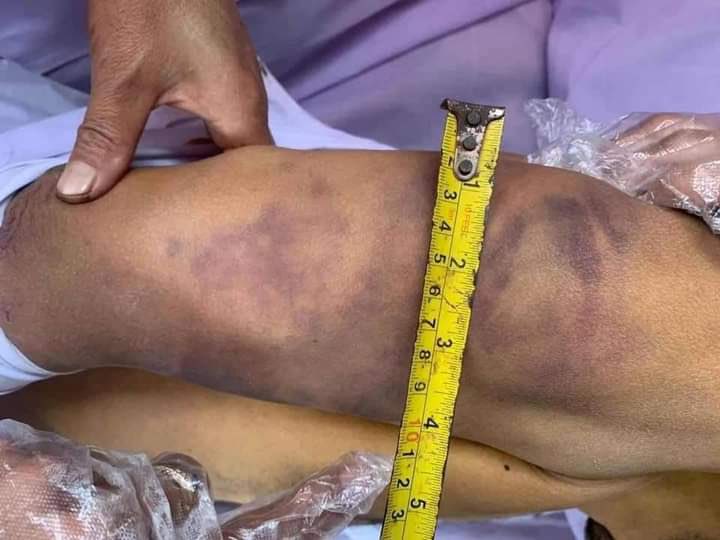 shafiur's tweet photo. #Mar7Coup TORTURE KILLING Muse, northern Shan State. 

February 28 - Arrested 
March 5 - Body returned with extensive signs of torture. NLD member. 

#WhatsHappeningInMyanmar #myanmar #MyanmarMilitary https://t.co/ZxsxsbJxKs