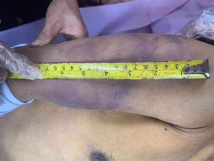 shafiur's tweet photo. #Mar7Coup TORTURE KILLING Muse, northern Shan State. 

February 28 - Arrested 
March 5 - Body returned with extensive signs of torture. NLD member. 

#WhatsHappeningInMyanmar #myanmar #MyanmarMilitary https://t.co/ZxsxsbJxKs