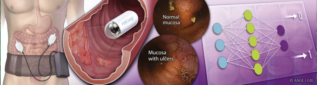 capsulendoscopy's tweet photo. Deep learning algorithms for automated detection of #Crohn’s disease ulcers by @capsulendoscopy . https://t.co/B7PvexTppB https://t.co/oH8vWGwIAp