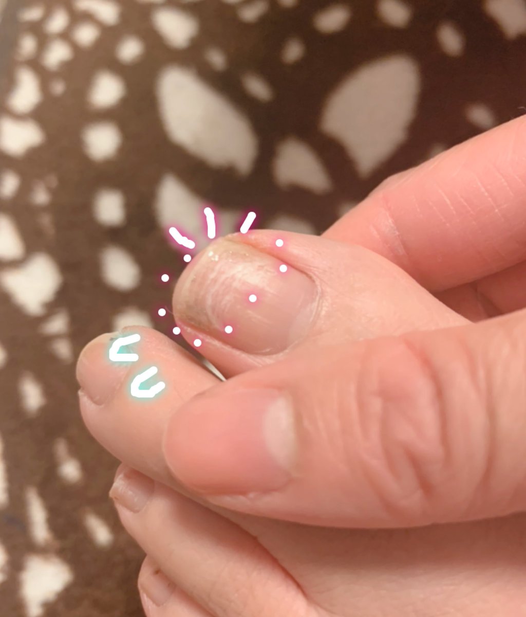 ぷりん 左足の親指の爪 1年ほど前から痒いなぁ と思っていて 最近痛いに変わったので皮膚科に行ったところ 爪カンジダでした 爪水虫だと思って市販の薬買わなくてよかった 爪カンジダ