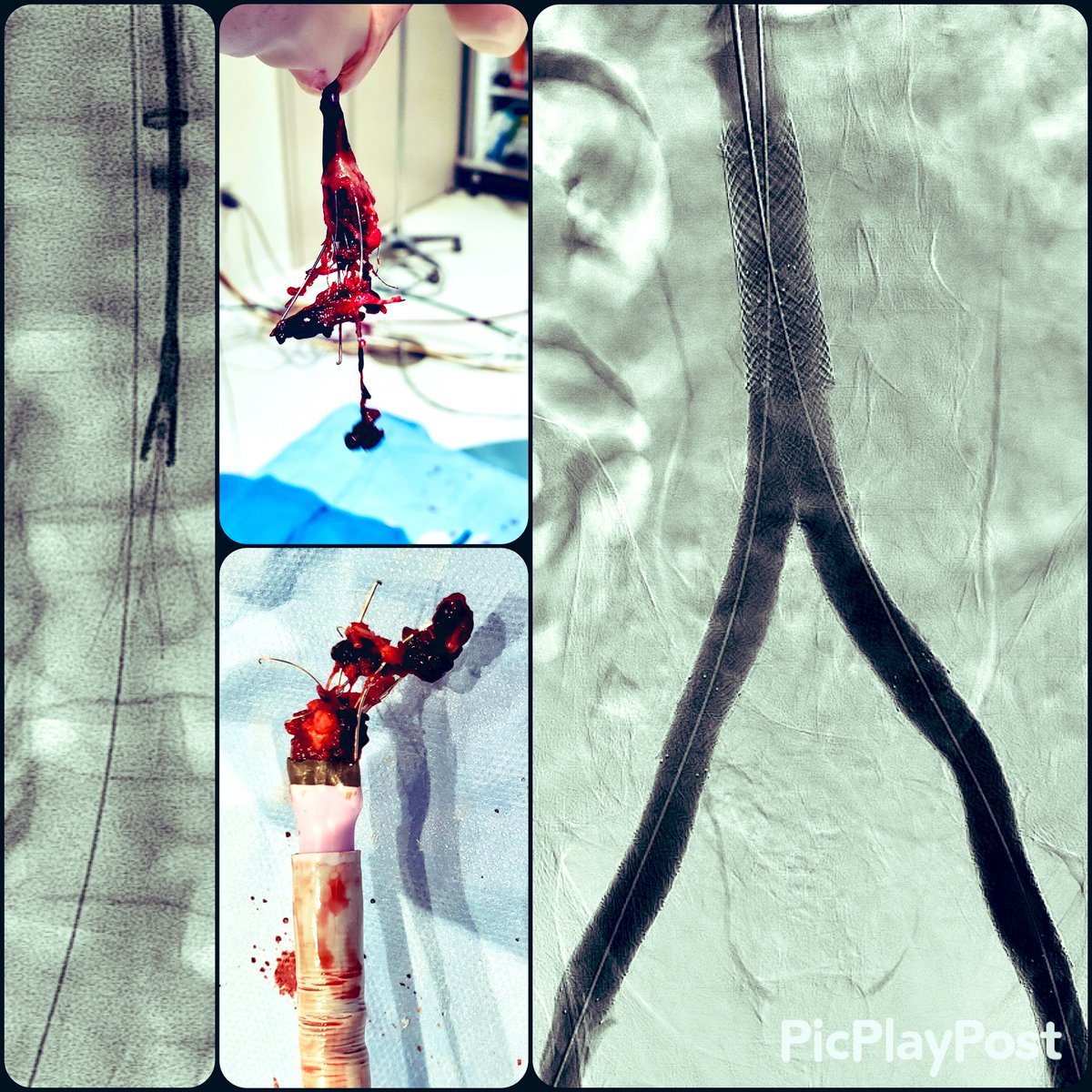 Gunther tulip filter placed 19yrs back now w/ complete iliocaval and b/l LE DVT. After @InariMedical Flowtriever & ClotTriever #SingleSessionThrombectomy, lots of elbow grease by @iRadRock & @vinitkhannamd, #filterOUT in 1 piece w/ beautiful double barrel recon. @SIR_ECS @SIRRFS