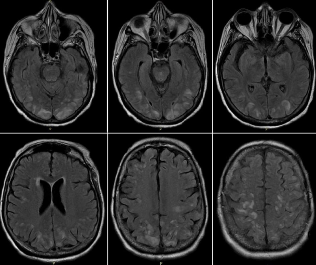 PanlarJ's tweet photo. ⚠️Marzo y la imagen del mes en @PanlarJ ‼️
🧏🏻‍♀️ de 23 años con diagnóstico de #lupus, presenta confusión mental, convulsiones tónico clónicas generalizadas y TA 180/100mmHg ➡️ Diagnóstico ❓❓ imagen cortesía del Dr. Francisco Martínez @fm2c https://t.co/nu1u9xWbEC