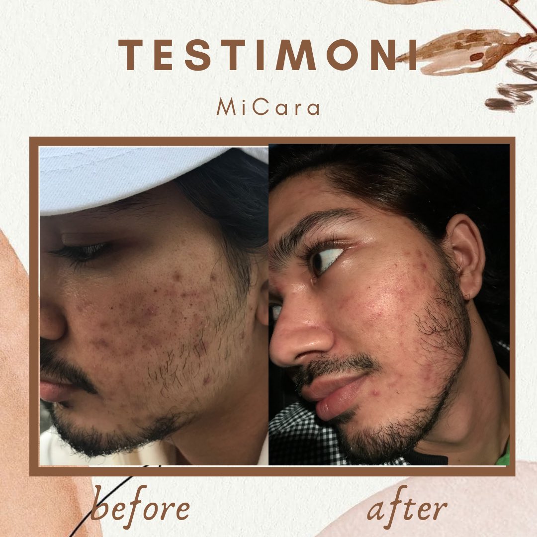micaraherbs's tweet photo. Opssss โผ๏ธ jangan kata lelaki pun tak boleh pakai Herbs Soap Cleaser ni tau! Lelaki pun kena jaga skin muka utk nampak lagi handsome gitu! Thank you share our testimoni with us ๐ฅฐ
.
#feedbackmicara #testimonimicara #herbssoaphomemade #masalahjerawatlelaki #skinlelaki #breakoutskin https://t.co/ZhHYYBtPew