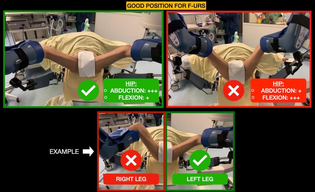 T&amp;TV44: RIRS &amp; Positioning. The regular position is the «LITHOTOMY»one. In fact it’s more a gynecologist one. Important points are: ABDUCTION of Hips+++ &amp; Limited FLEXION. In special situation it is always possible to leave the legs straight, stay beside and use Flexi Cysto &amp;Furs