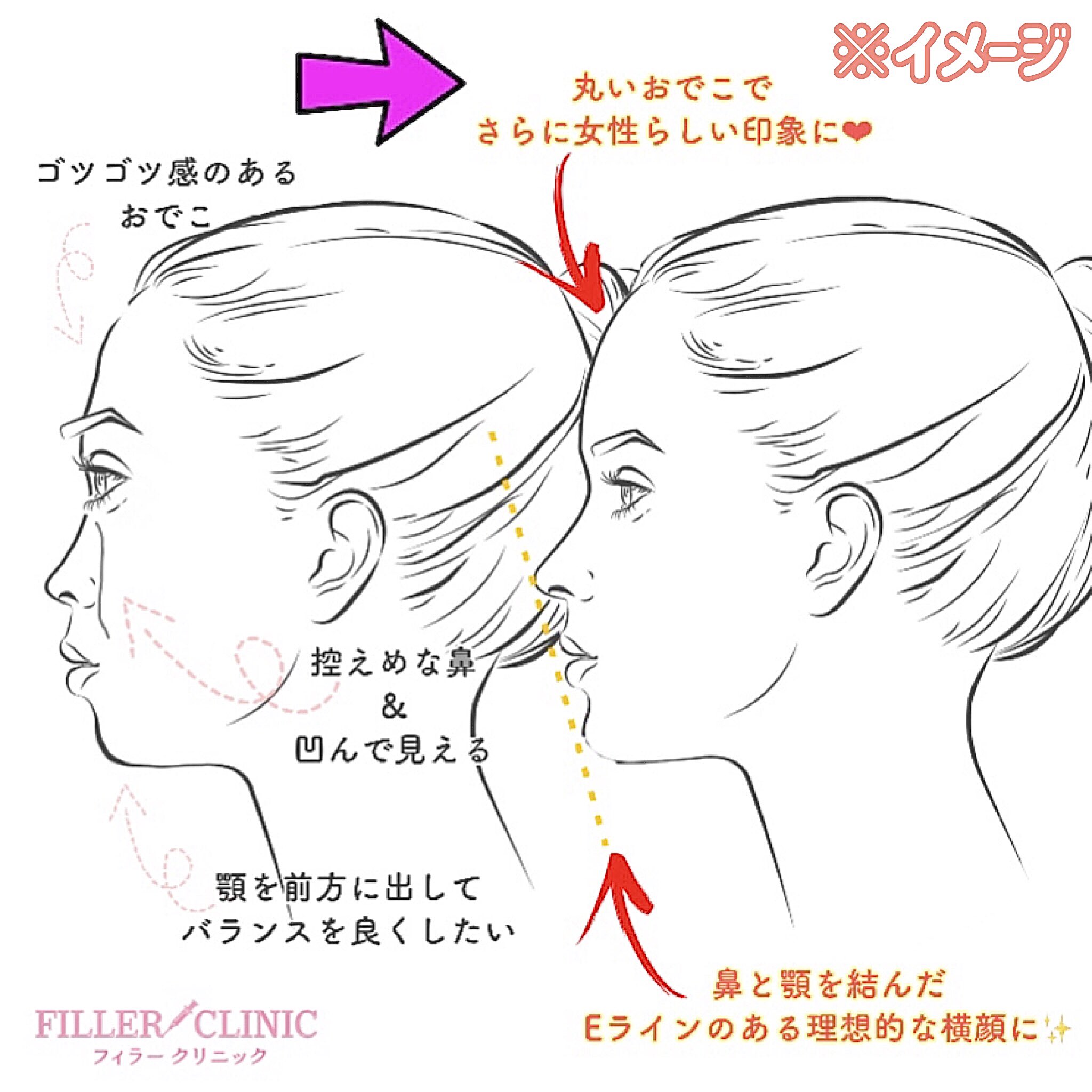 フィラークリニック 公式 綺麗なeラインを作りたい フィラーでできる 美しい横顔 は 目を見て話している時以外は 横顔がよく見られています 切らないからダウンタイムもなし 気軽にイメチェン T Co Pkjamigcag フィラー