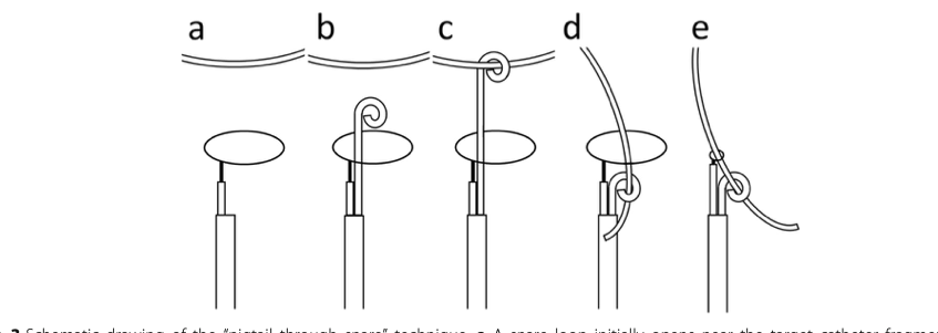 gruMAVe's tweet photo. Empezamos el lunes con complicaciones que NO debieran ocurrir.  Maravilloso el trabajo de los compañeros de Radiología vascular. En este caso utilizando la técnica  “pigtail through snare”
para recuperar un fragmento de catéter. https://t.co/LO12xryYj0 https://t.co/9l0ZlPO6xk