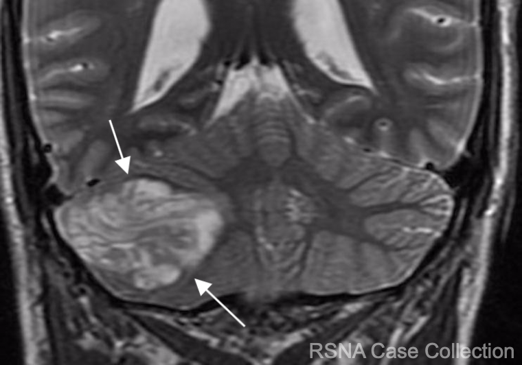 “Heads up!” There is a new @RSNA #RSNACC Case of the week! What’s the diagnosis in this 47 yo with headaches and dizziness?  bit.ly/3sRhGj9
@RSNA @TheASNR @theASFNR @TheAJNR  @JNeuroradiology @ESNRad 

#NeuroRad #RadEd #brainimaging