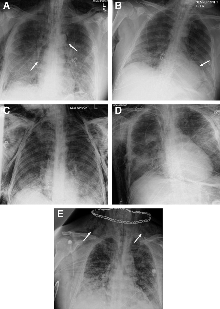 PatologCritica's tweet photo. #Neumomediastino en pacientes con Síndrome de Dificultad Respiratoria Aguda por #COVID19
En la American Journal of Respiratory and Critical Care Medicine: https://t.co/kDqHAHBr2M
#SDRA https://t.co/Xe0nXZzU0M