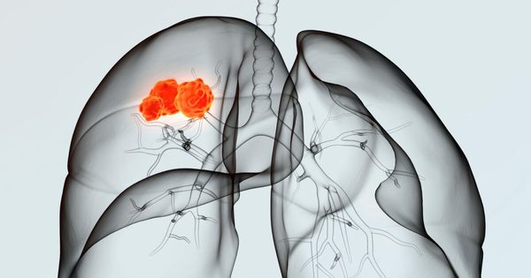 axelrod_eric's tweet image. #digr_io Deep Learning May Help Doctors Choose Better Lung Cancer Treatments upflow.co/l/CFtW